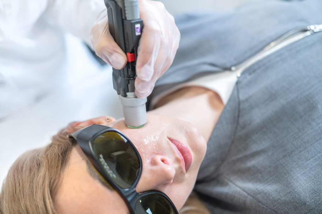 Kraujagyslinių odos darinių šalinimas lazeriu