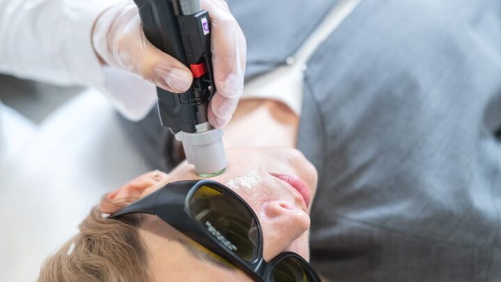 Kraujagyslinių odos darinių šalinimas aleksandrito ar diodiniu lazeriu