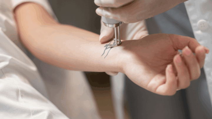 Tatuiruočių / permanentinio makiažo šalinimas lazeriu